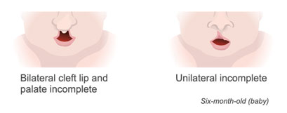 bilateral cleft lip