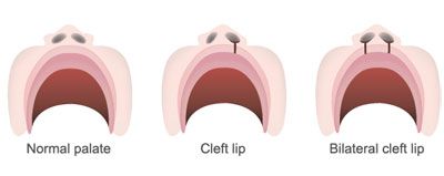 cleft lip