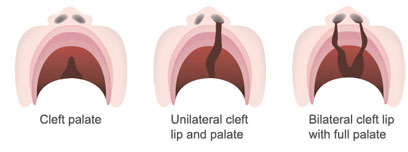 cleft palate